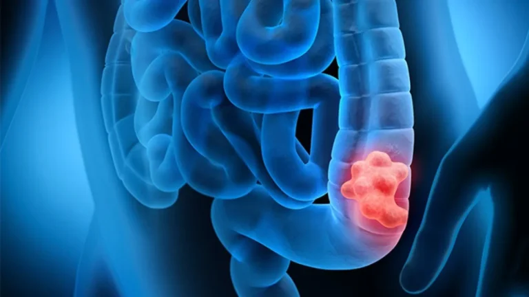 Il cancro colpisce sempre più giovani e non si capisce perché: “Numeri allarmanti”