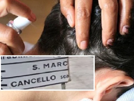 Allarme pidocchi in una scuola: mamme disperate