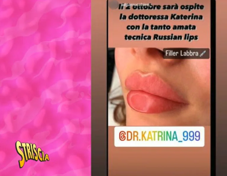 Russian Lips, l’operazione abusiva diventa domestica: Striscia la Notizia arriva a Caserta