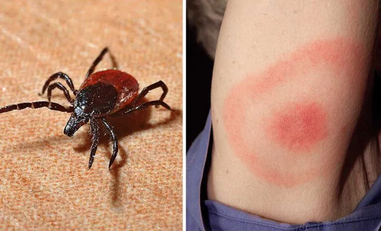 Bambina punta da una zecca, diagnosticata malattia di Lyme