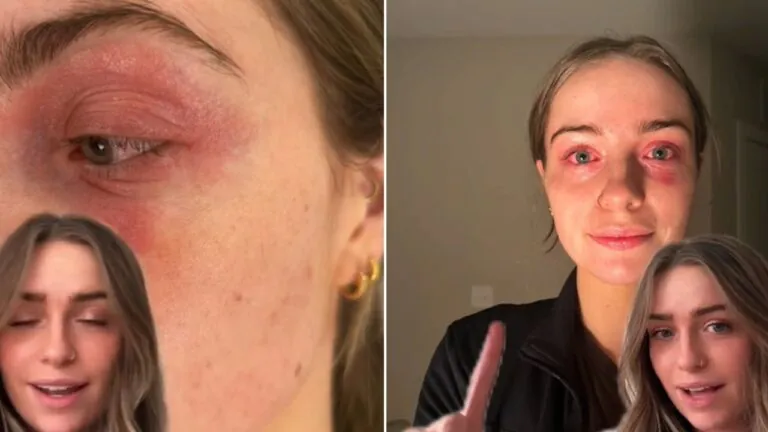 “Ho comprato degli orecchini su questo sito popolare e mi hanno avvelenata, fate attenzione”: la denuncia di una ragazza