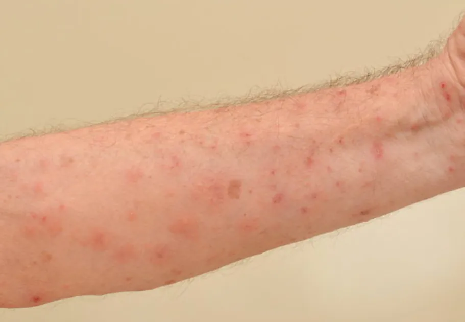 scabbia sintomi
