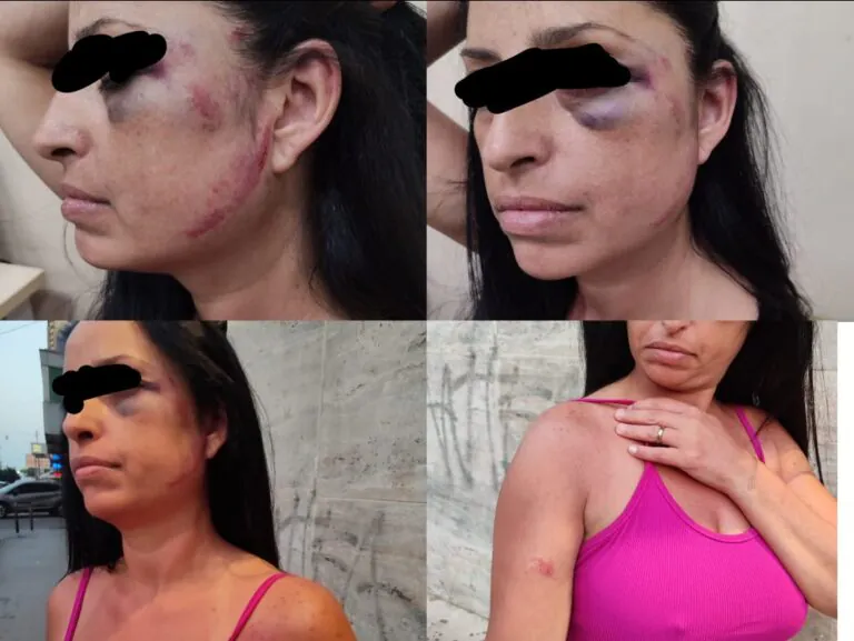 Aggressione choc in casa: donna pestata a sangue dal ragazzo della figlia