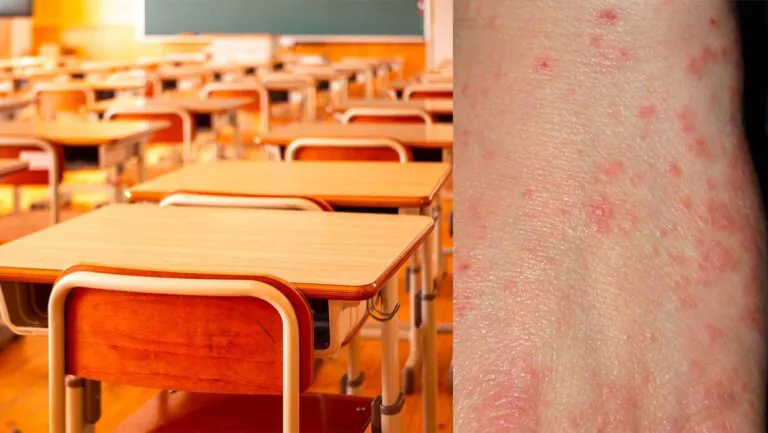 Accertato un caso di scabbia in una scuola primaria