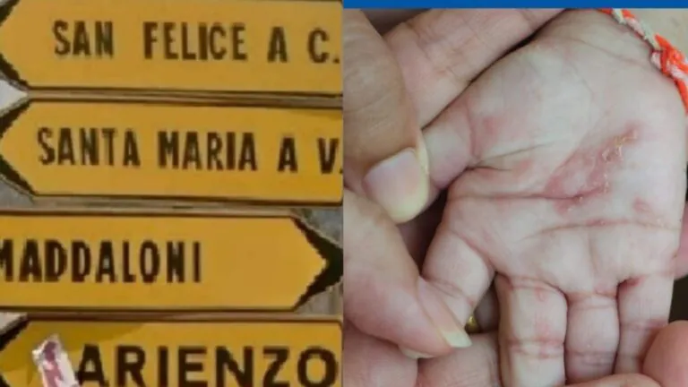 Caso di scabbia all’asilo nido, il plesso resta aperto. L’Ente: “Caso lieve”. L’opposizione attacca